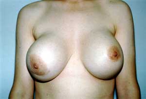 Photograph of grade IV capsular contracture in the right breast of a 29-year-old woman seven years after subglandular placement of 560cc silicone gel-filled breast implants