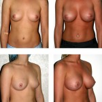 Breast implant diagram