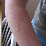 A human arm, four hours after IPL treatment. The raised bumps and red colouration around each hair follicle are typical of this treatment. This normally subsides after three or four days.